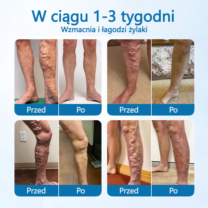 Timilk® VeinGuard Herbal Spray-✅ Klinicznie udowodniono, że eliminuje żylaki w zaledwie 7 dni!💚