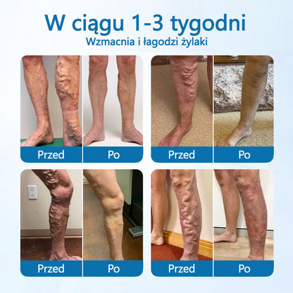 Timilk® VeinGuard Herbal Spray-✅ Klinicznie udowodniono, że eliminuje żylaki w zaledwie 7 dni!💚