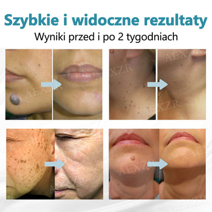 Cvreoz® nowy nieinwazyjny laser do usuwania pieprzyków i brodawek 🎉