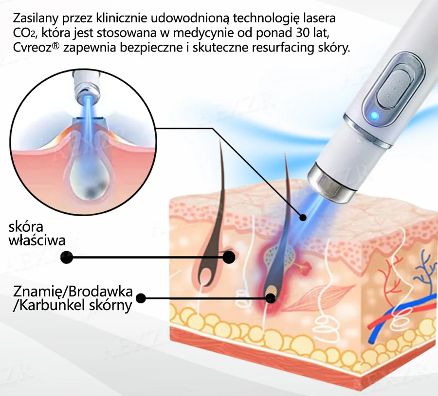 Cvreoz® nowy nieinwazyjny laser do usuwania pieprzyków i brodawek 🎉