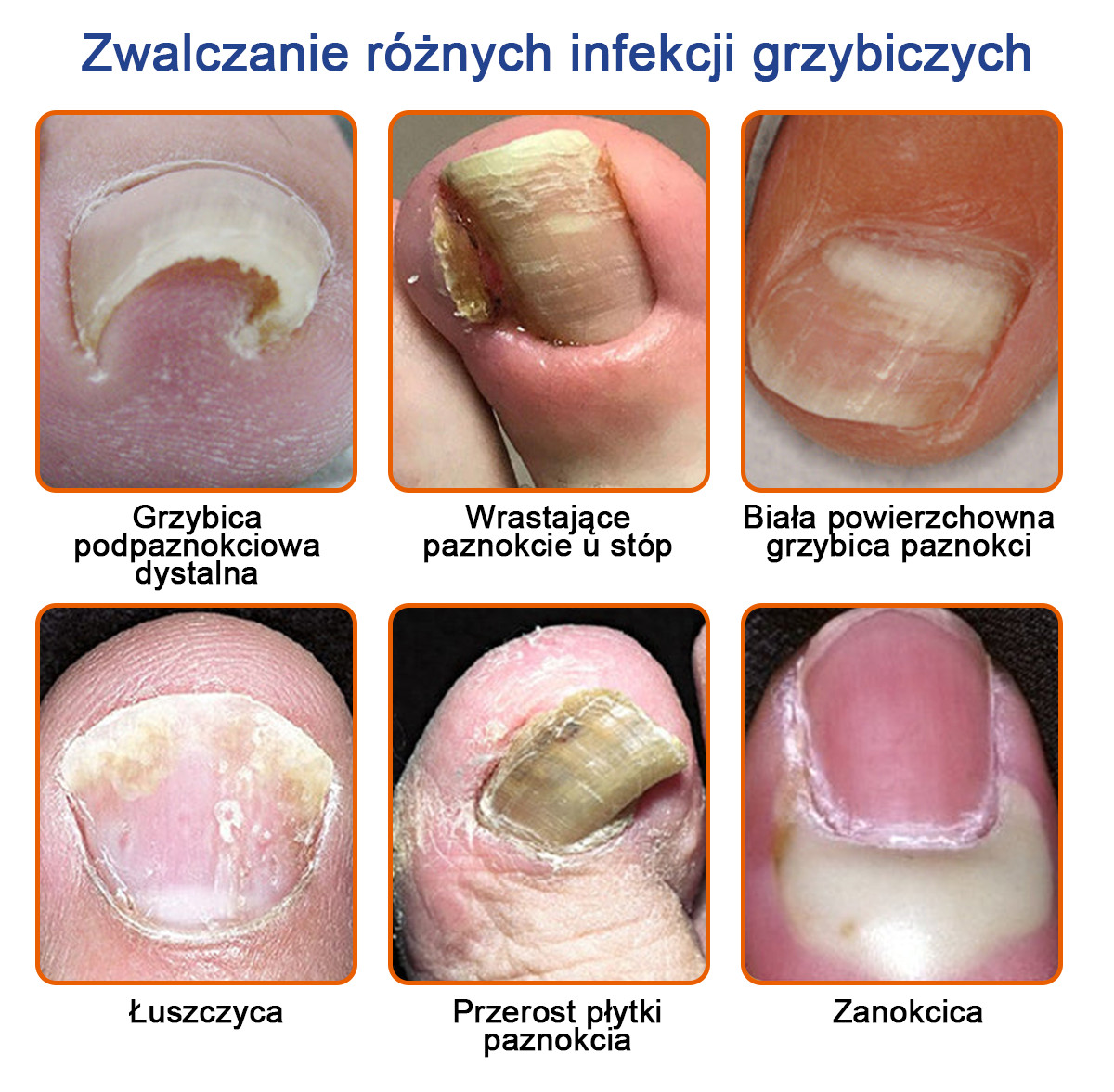 🐝👣Furzero™ Bienengift Nagelpilz Leczenie: Całkowite rozwiązanie problemu grzybicy paznokci🌟👣👣