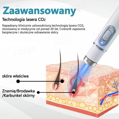 Cvreoz® nowy nieinwazyjny laser do usuwania pieprzyków i brodawek 🎉