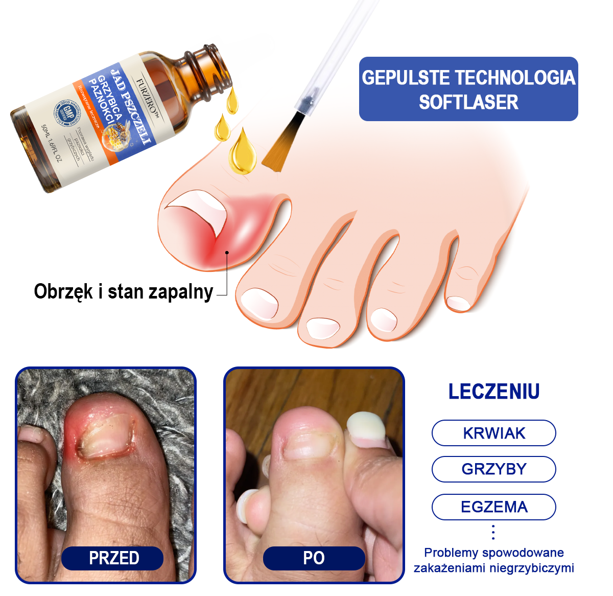 🐝👣Furzero™ Bienengift Nagelpilz Leczenie: Całkowite rozwiązanie problemu grzybicy paznokci🌟👣👣